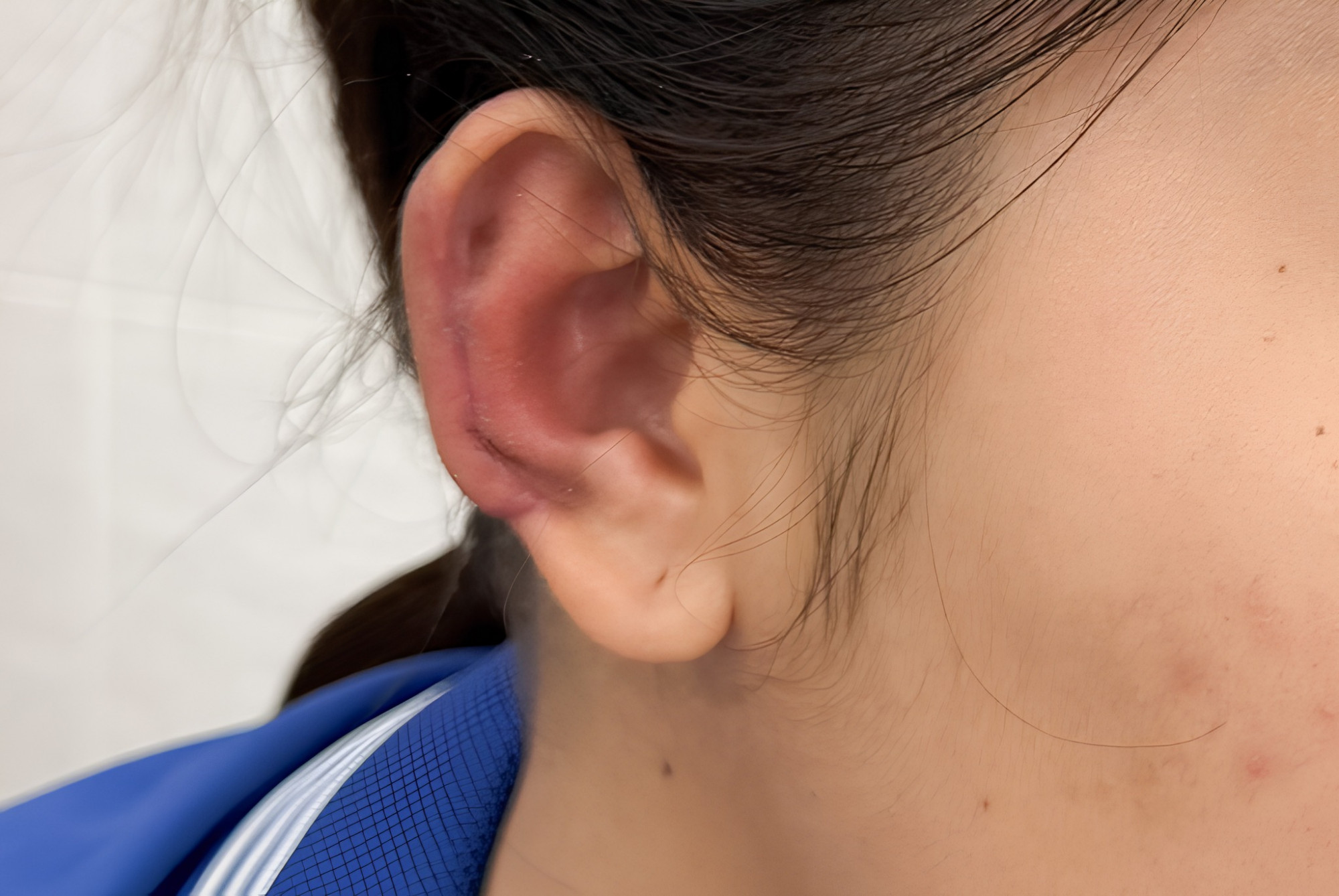 Chị T. tự tin hơn sau khi được tái tạo vành tai, ảnh BVTN