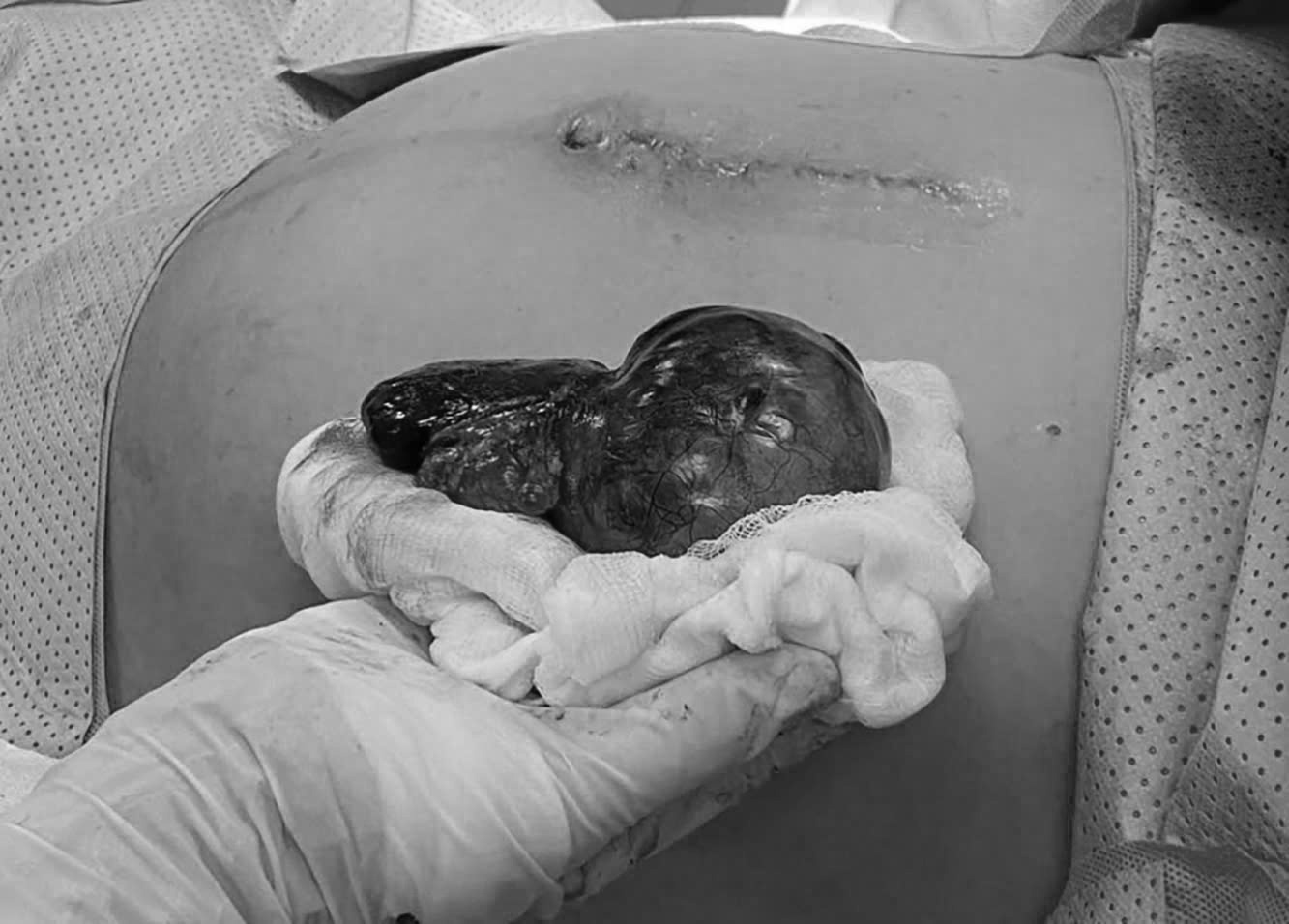 Khối u xoắn được bác sĩ xử lý lấy ra ngoài cho chị H., ảnh BVCC