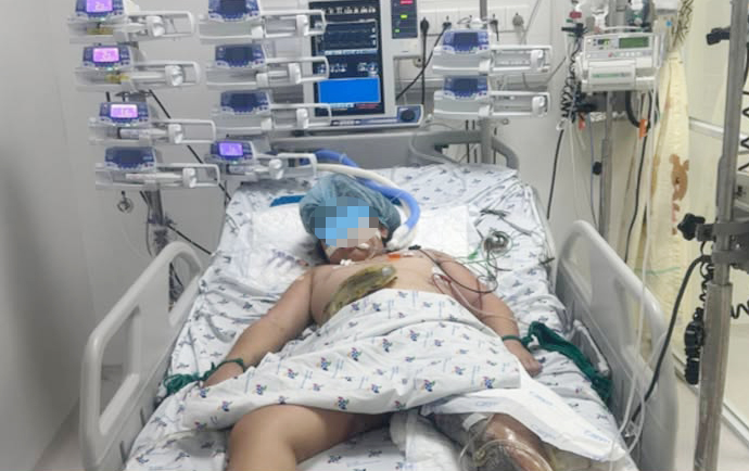 Bé T. khi còn điều trị tại Bệnh viện Nhi đồng Thành phố, ảnh BVCC