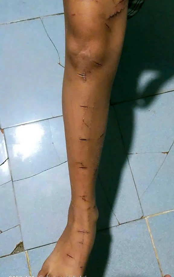 Những vết thương người cháu N. - học sinh lớp 5 Trường Tiểu học 1 Khánh Bình Tây Bắc, xã Đá Bạc, tỉnh Cà Mau. Ảnh: Gia đình cung cấp