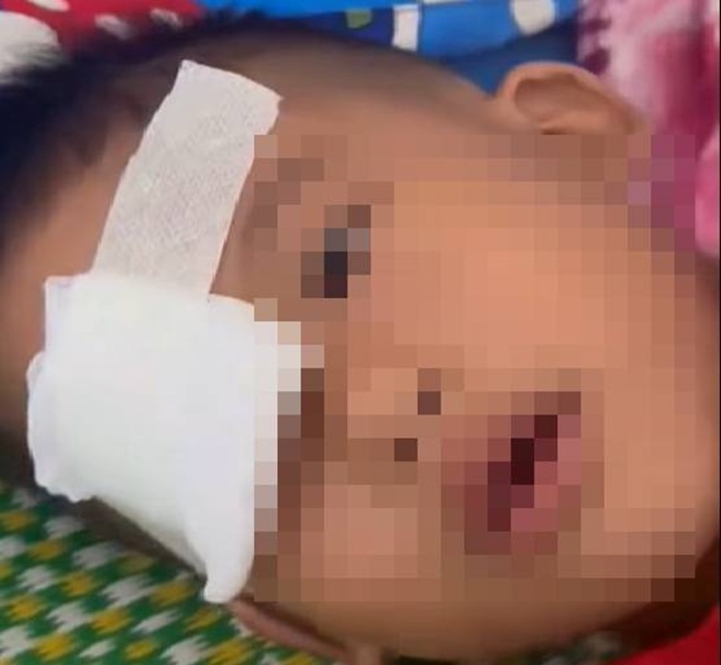 Em T. bị thương một bên mắt - ảnh: MXH