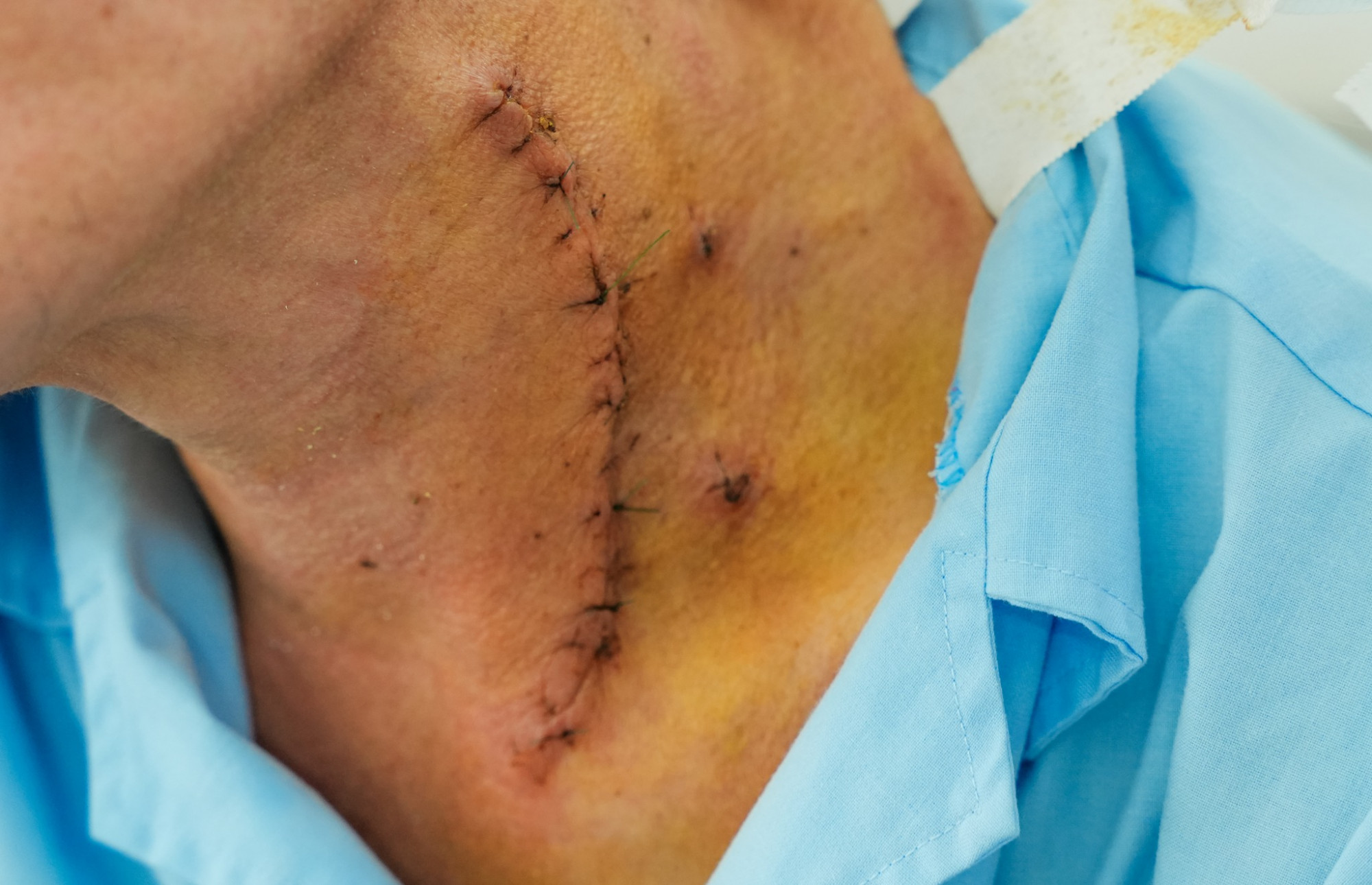 Bác sĩ phải mổ một đoạn dài ở thực quản của ông Q. để lấy mảnh xương, ảnh BVCC