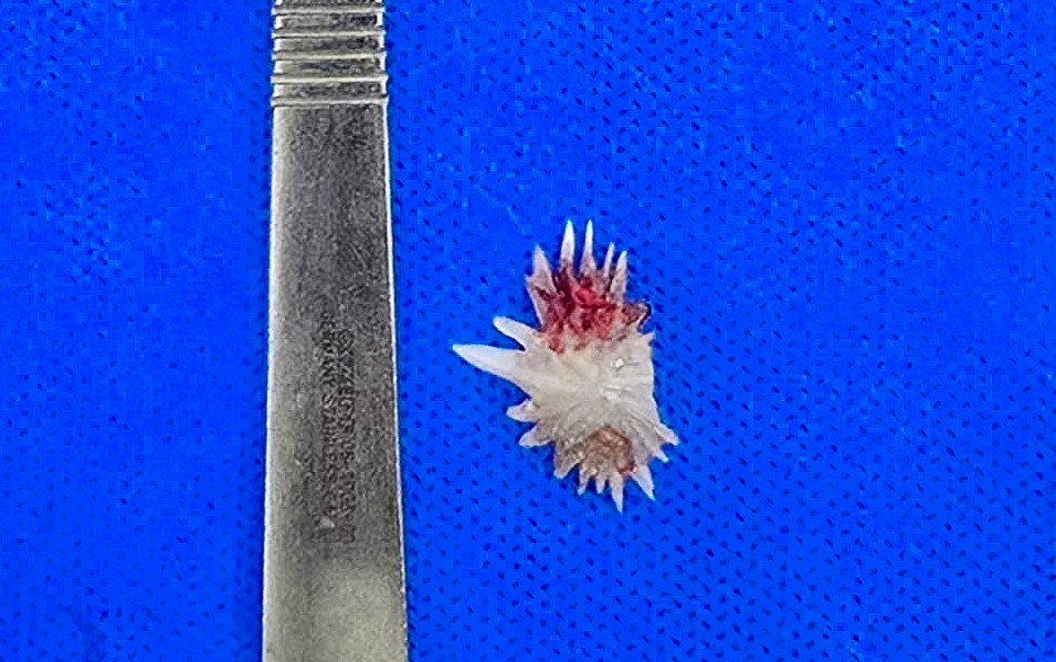 Mảnh xương có nhiều cạnh sắc nhọn khiến cho các bác sĩ không thể nội soi xử lý, ảnh BVCC