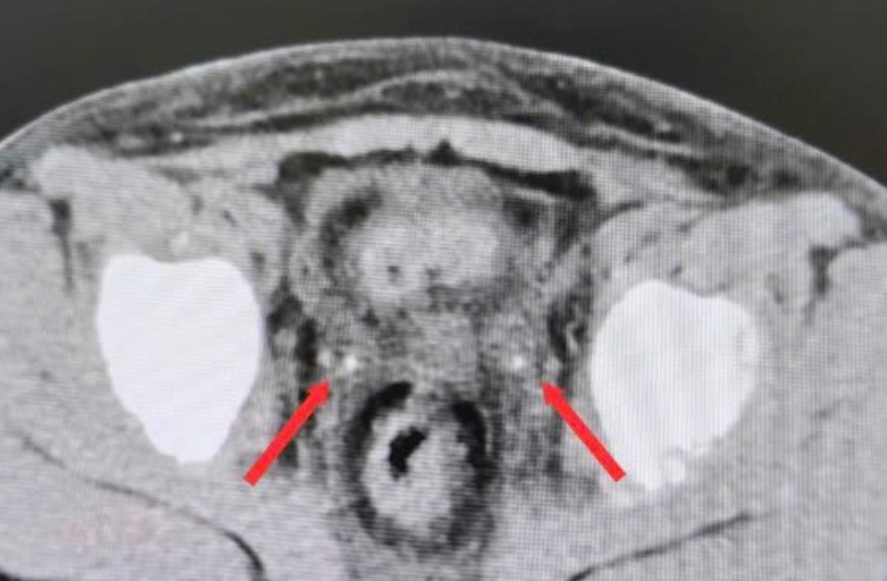 2 viên sỏi trong niệu quản của bé trai qua chẩn đoán hình ảnh, ảnh BV