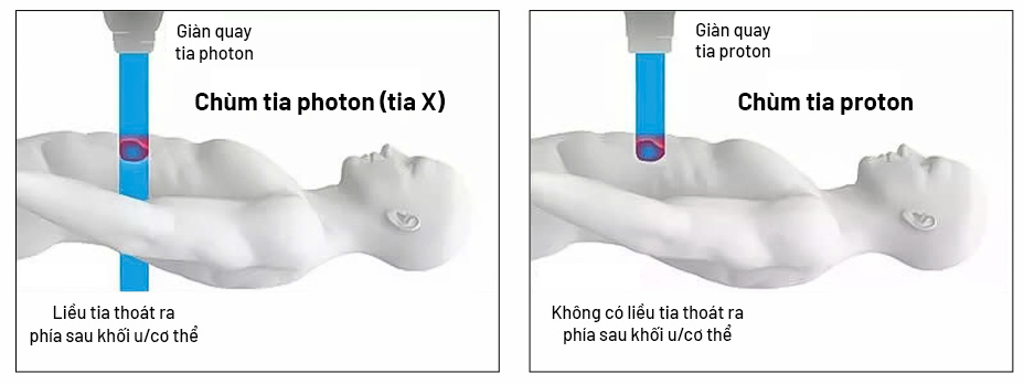 Xạ trị proton hiện đại với tia năng lượng biết “dừng đúng chỗ” ngay vị trí khối u để tiêu diệt khối u hiệu quả và an toàn cao