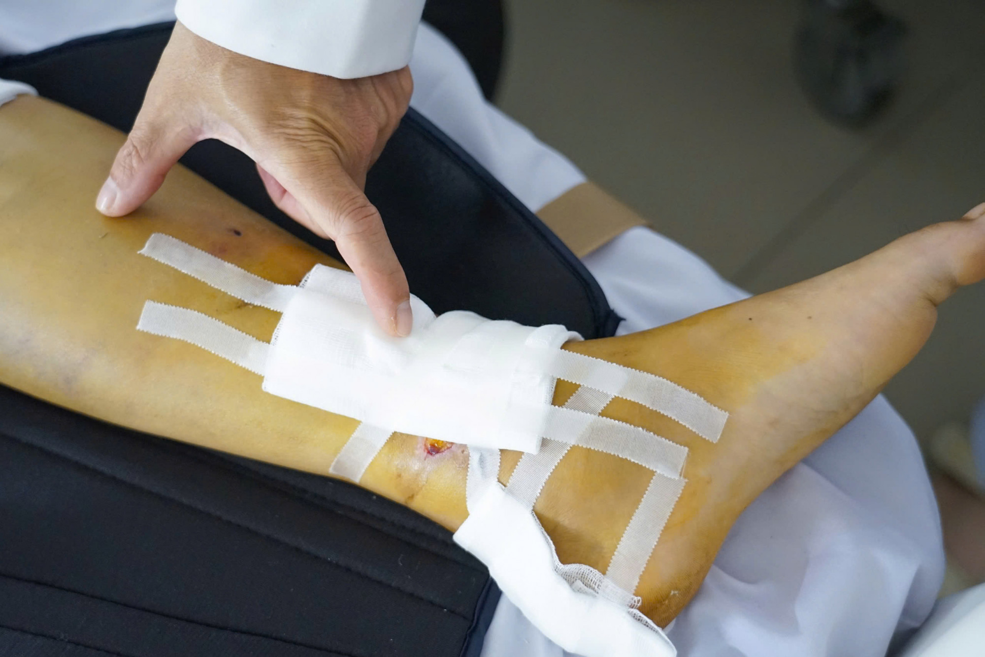 Việc cấp cứu, điều trị kịp thời giúp anh K. thoát khỏi tật nguyền sau tai nạn, ảnh BVCC