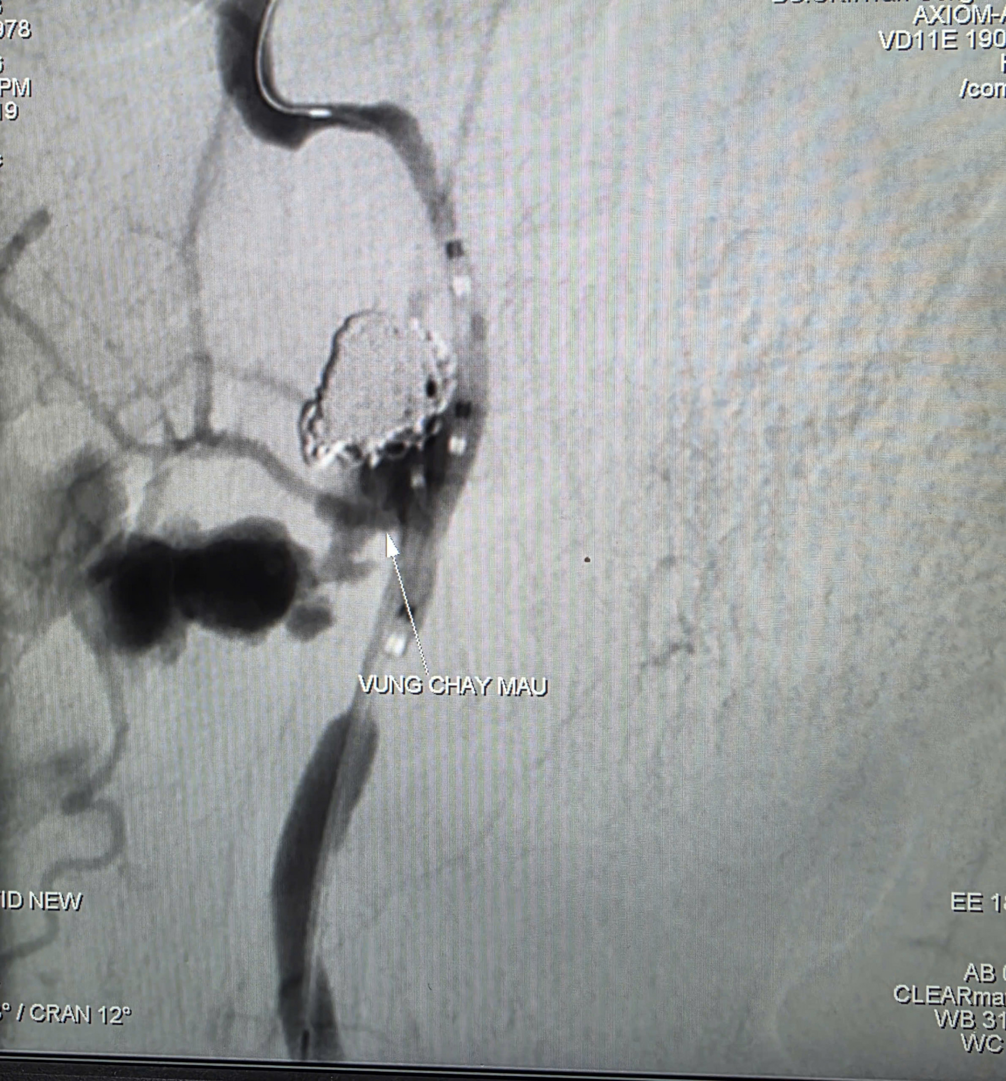 Hình ảnh bệnh nhân chảy máu trước khi can thiệp... Ảnh: CTV