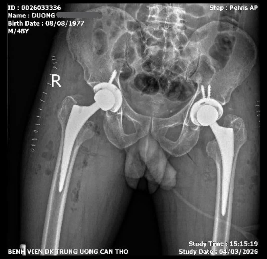 Phẫu thuật ít xâm lấn, thay khớp háng 2 bên thành công cùng lúc cho bệnh nhân 