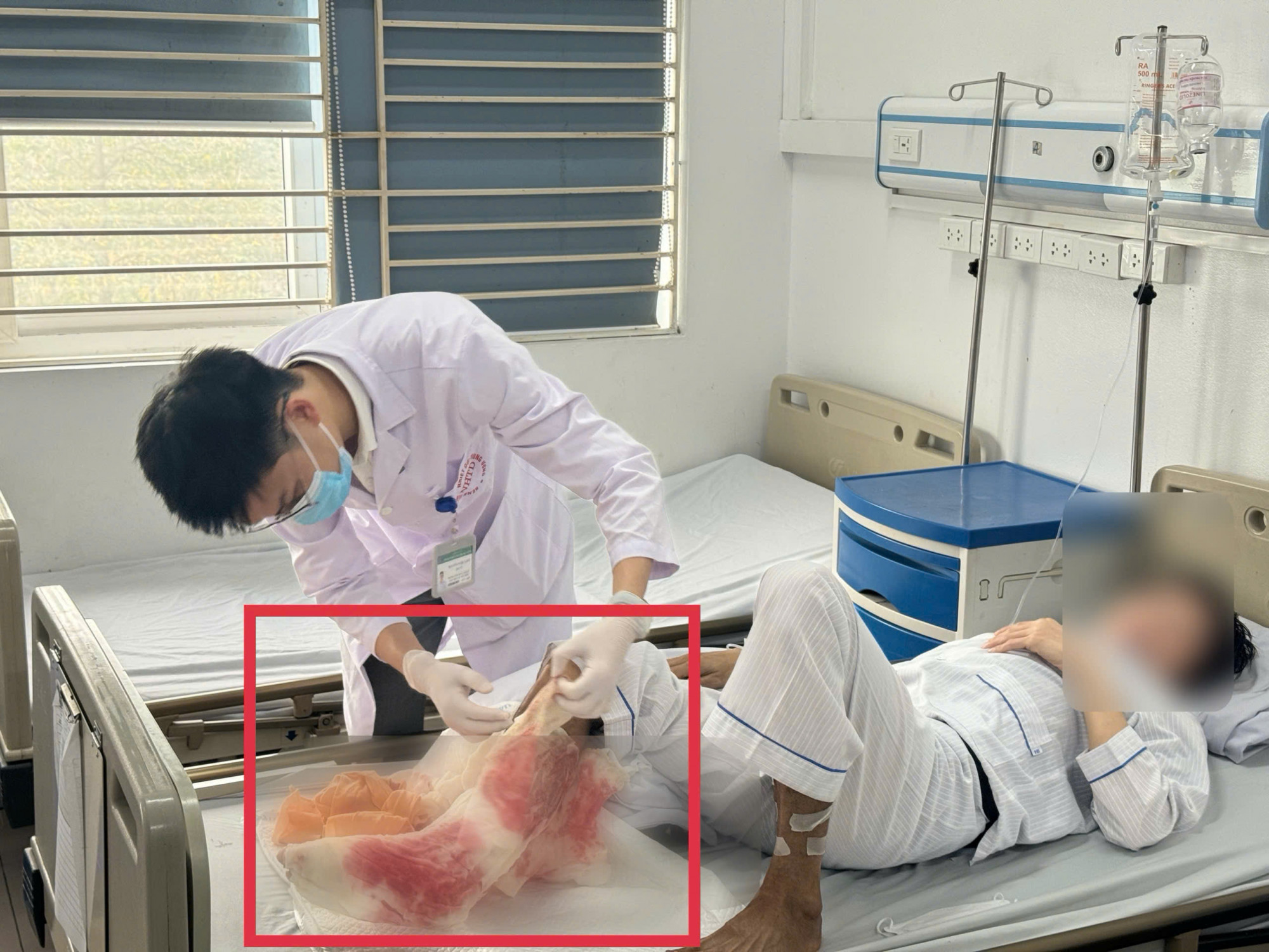 Bác sĩ chăm sóc nam bệnh nhân bị hoại tử chân do đắp thuốc lá - ảnh: T.S.