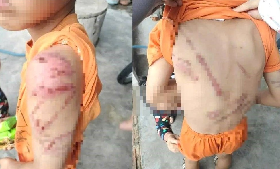 Những vết bầm tím trên cơ thể cháu D. thời điểm sau khi bị đánh - ảnh: MXH