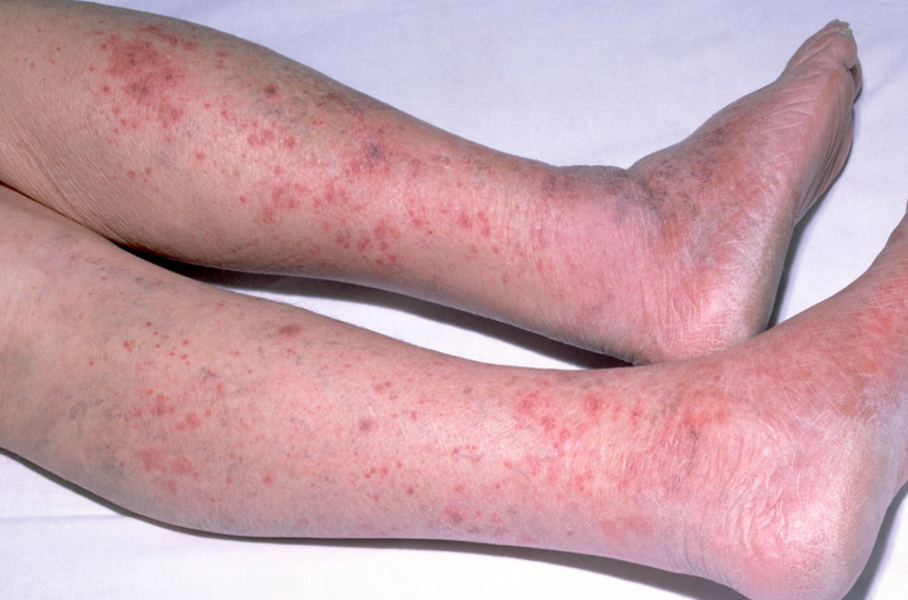 Triệu chứng bệnh viên màng não mô cầu - Ảnh Internet