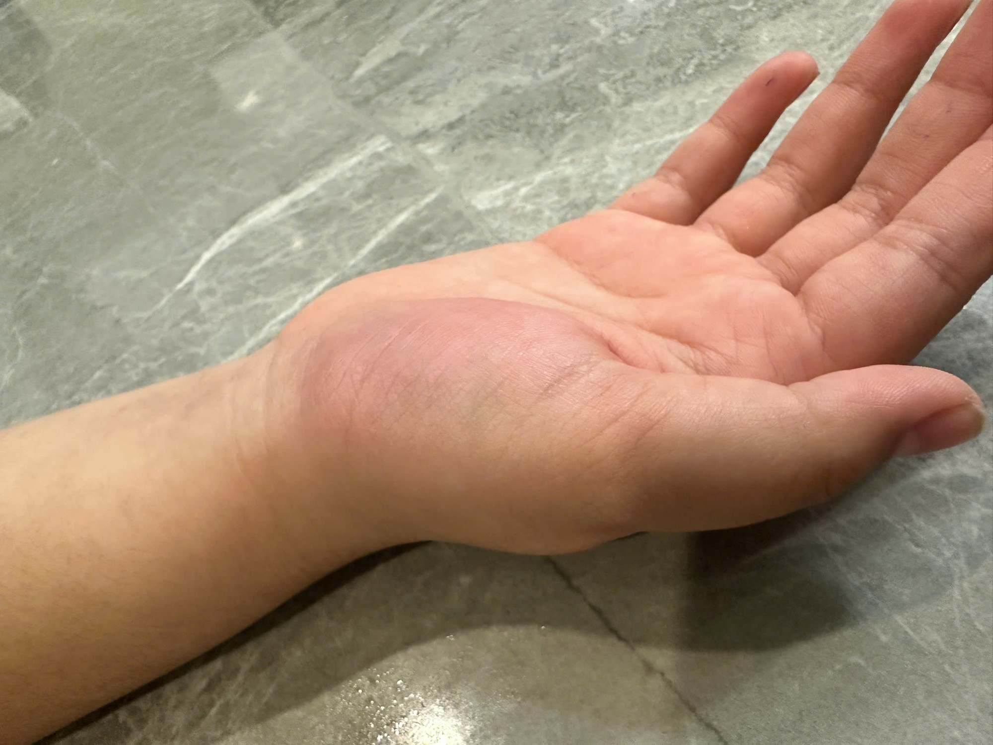 Bàn tay cháu TH. bị đánh- Ảnh người nhà cung cấp