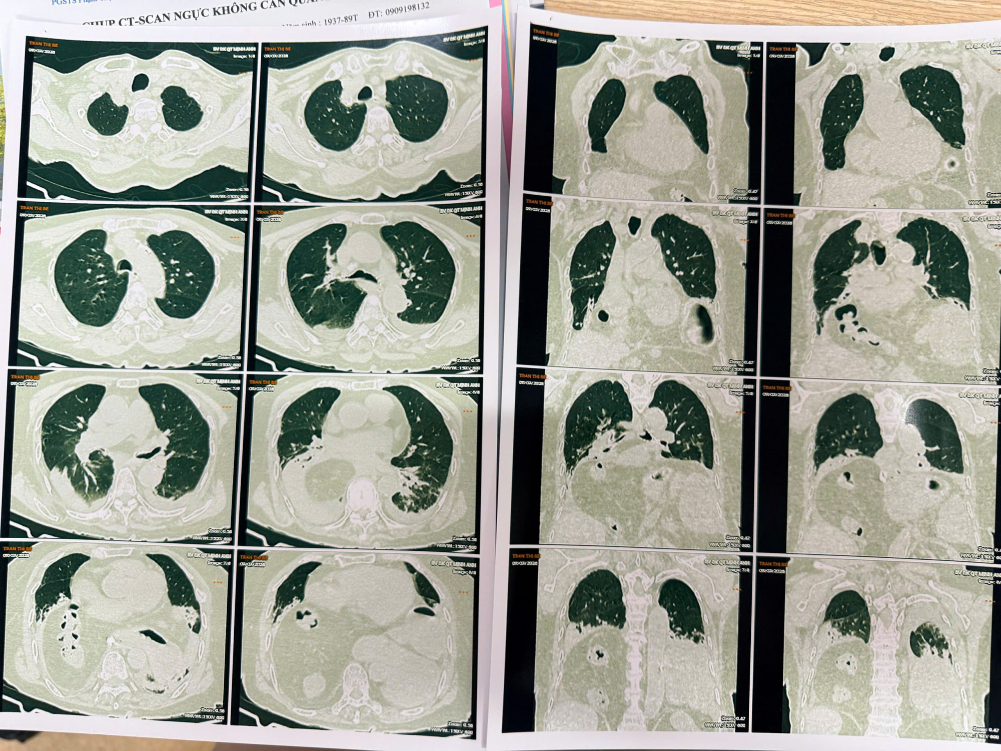 Hình chụp cắt lớp điện toán đa lát cắt ca thoát vị của bà cụ 90 tuổi (ảnh: BVCC)