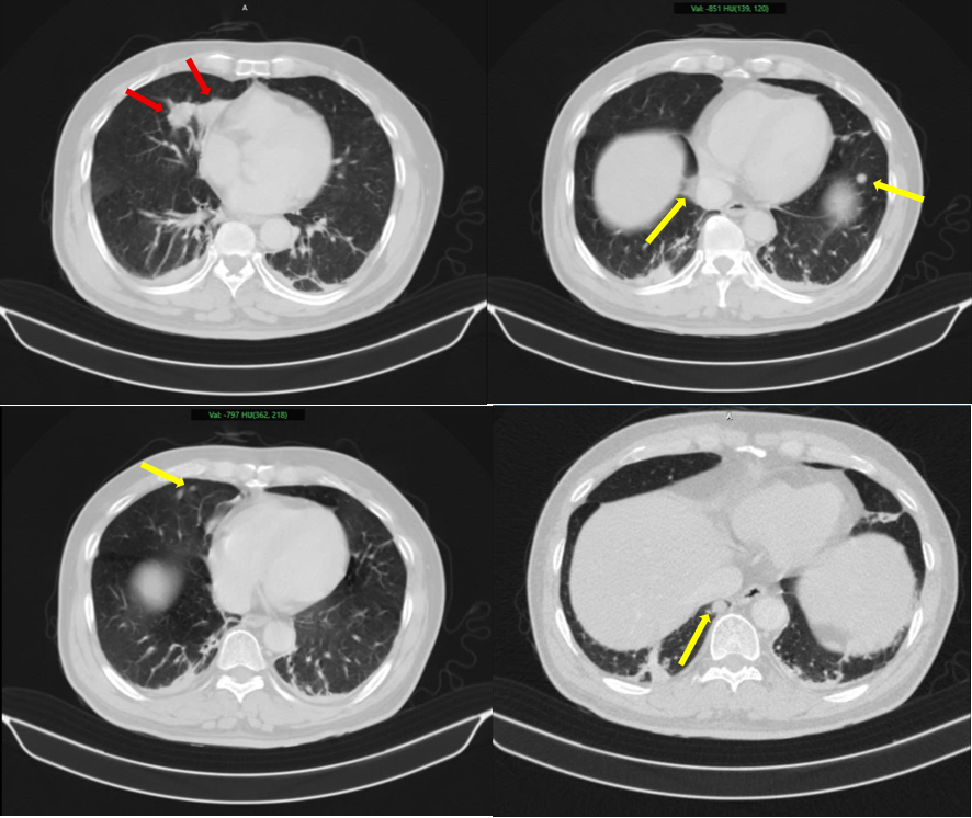 Hình ảnh 2 khối u của bệnh nhân - Bệnh viện cung cấp