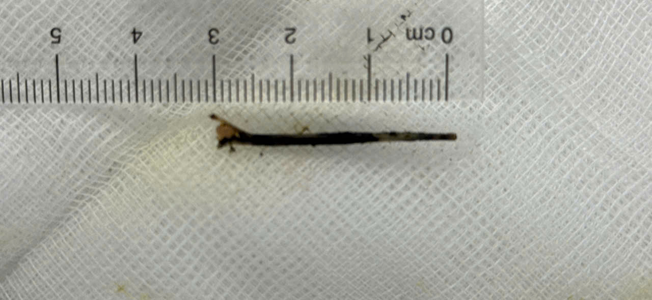 xương cá dài 3cm đâm xuyên vào đường mật