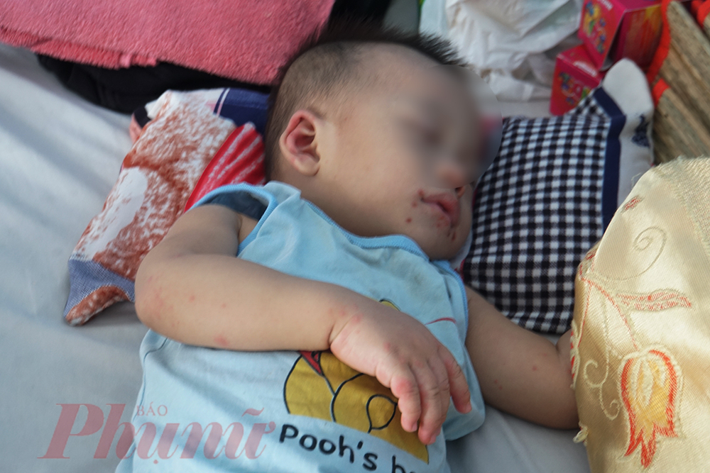 Chú thích ảnh: Trẻ mắc tay chân miệng cần được theo dõi, chăm sóc chặt chẽ, nếu tiến triển nặng phải đưa đến bệnh viện. Ảnh minh họa: Phạm An