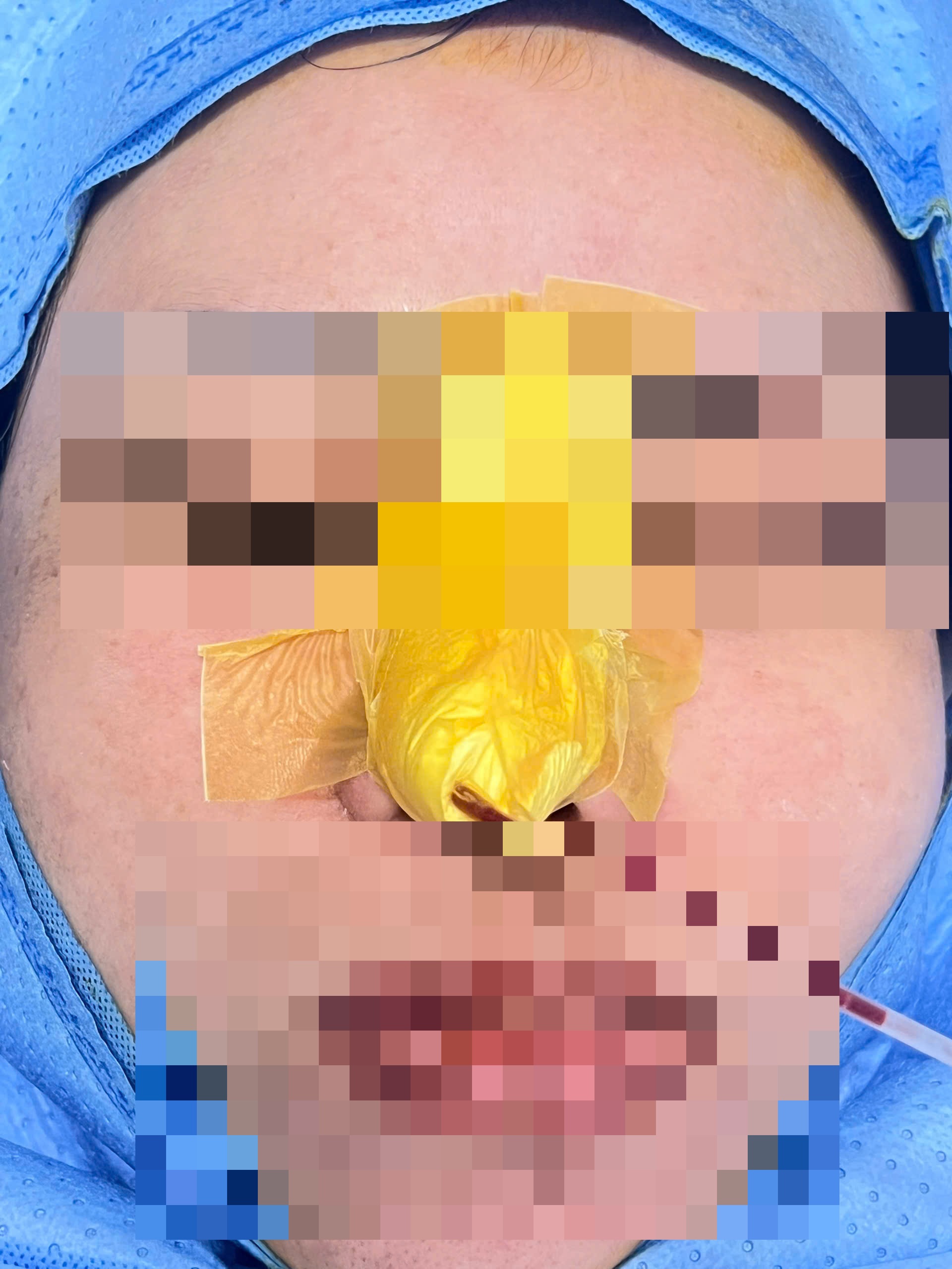 Bệnh nhân Lê Thị L., 34 tuổi ở phường Vỹ Dạ (TP Huế) vừa được các bác sĩ phẫu thuật thành công