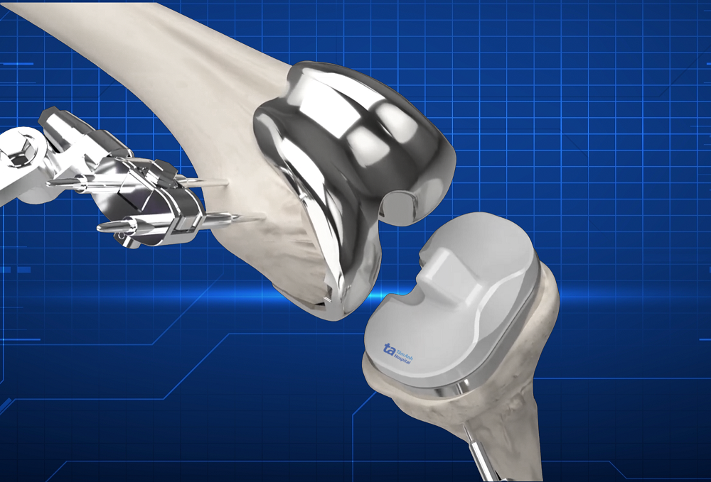 Mô phỏng quá trình lắp khớp chuẩn xác, tương thích nhiều loại khớp nhân tạo khác nhau phù hợp từng người bệnh - Ảnh: Bệnh viện Đa khoa Tâm Anh