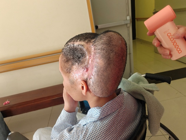 Chị Đ. sau khi phẫu thuật não và đặt túi giãn da đầu có tóc 