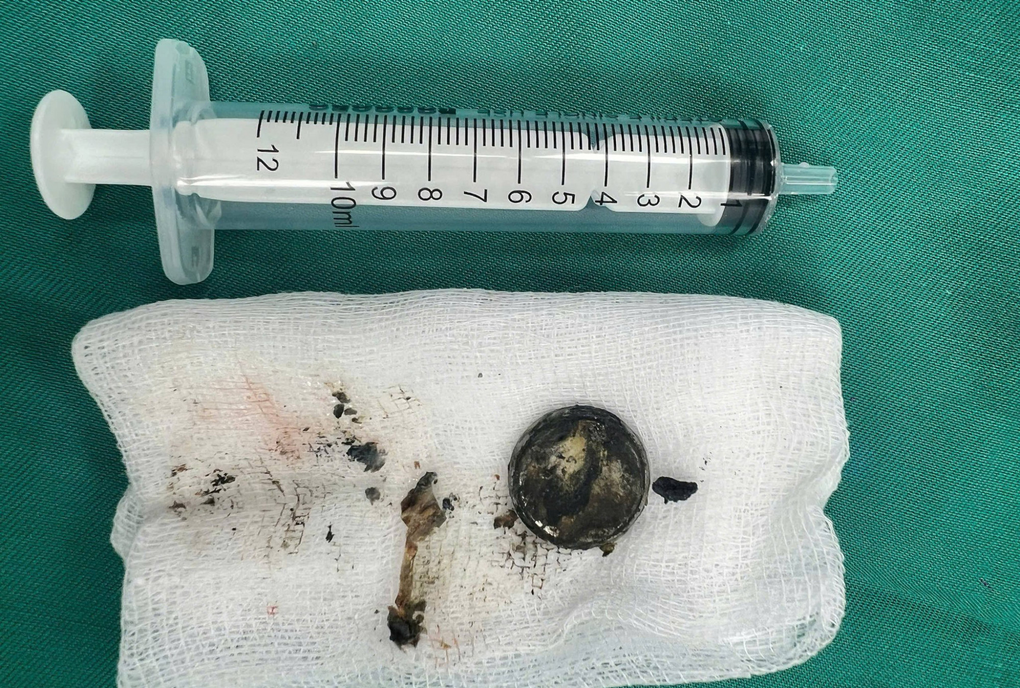 Viên pin cúc áo được lấy ra từ thực quản bệnh nhi - Ảnh: Khánh Trung