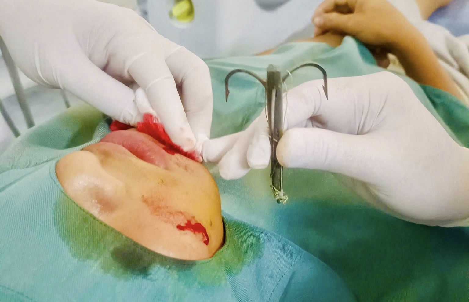 Lưỡi câu cá 3 cạnh được lấy ra khỏi mặt bệnh nhi - Ảnh: Khánh Trung