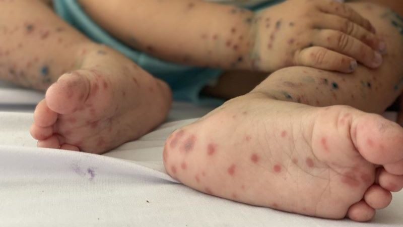 Bệnh tay chân miệng_Hình minh hoạ.