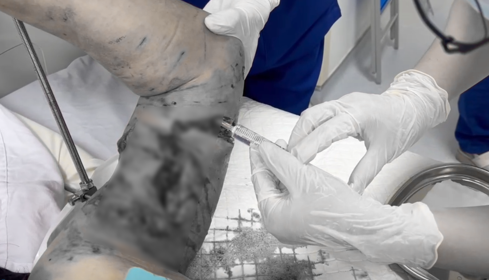 Bệnh nhân bị tổn thương nghiêm trọng vùng cánh tay do chó cắn - ảnh: bệnh viện cung cấp