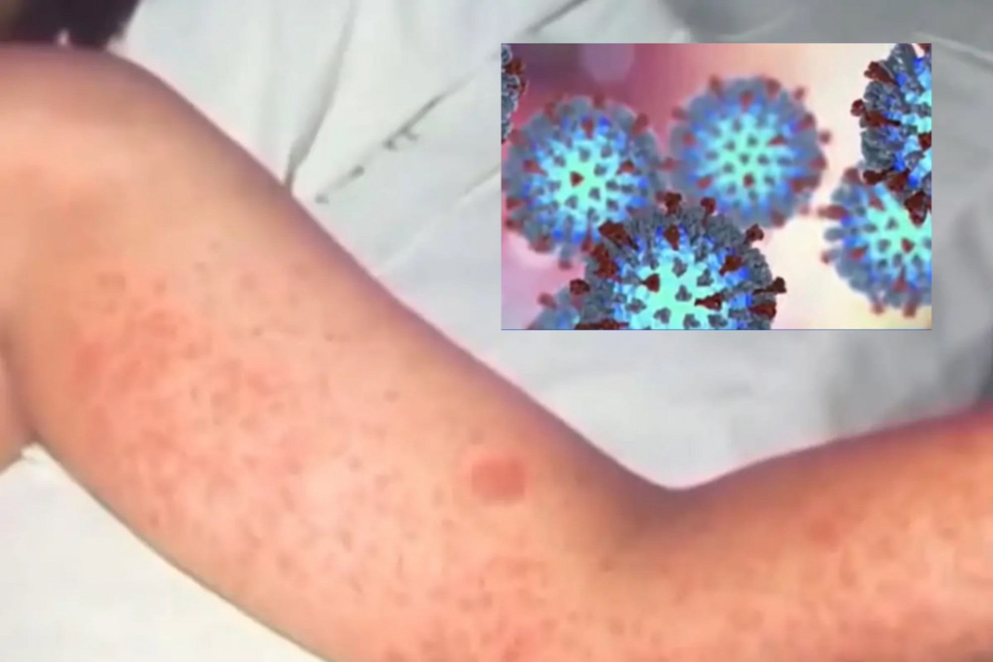 Sởi lan rộng, bang California đối mặt nguy cơ bùng phát dịch - Ảnh: KCRA