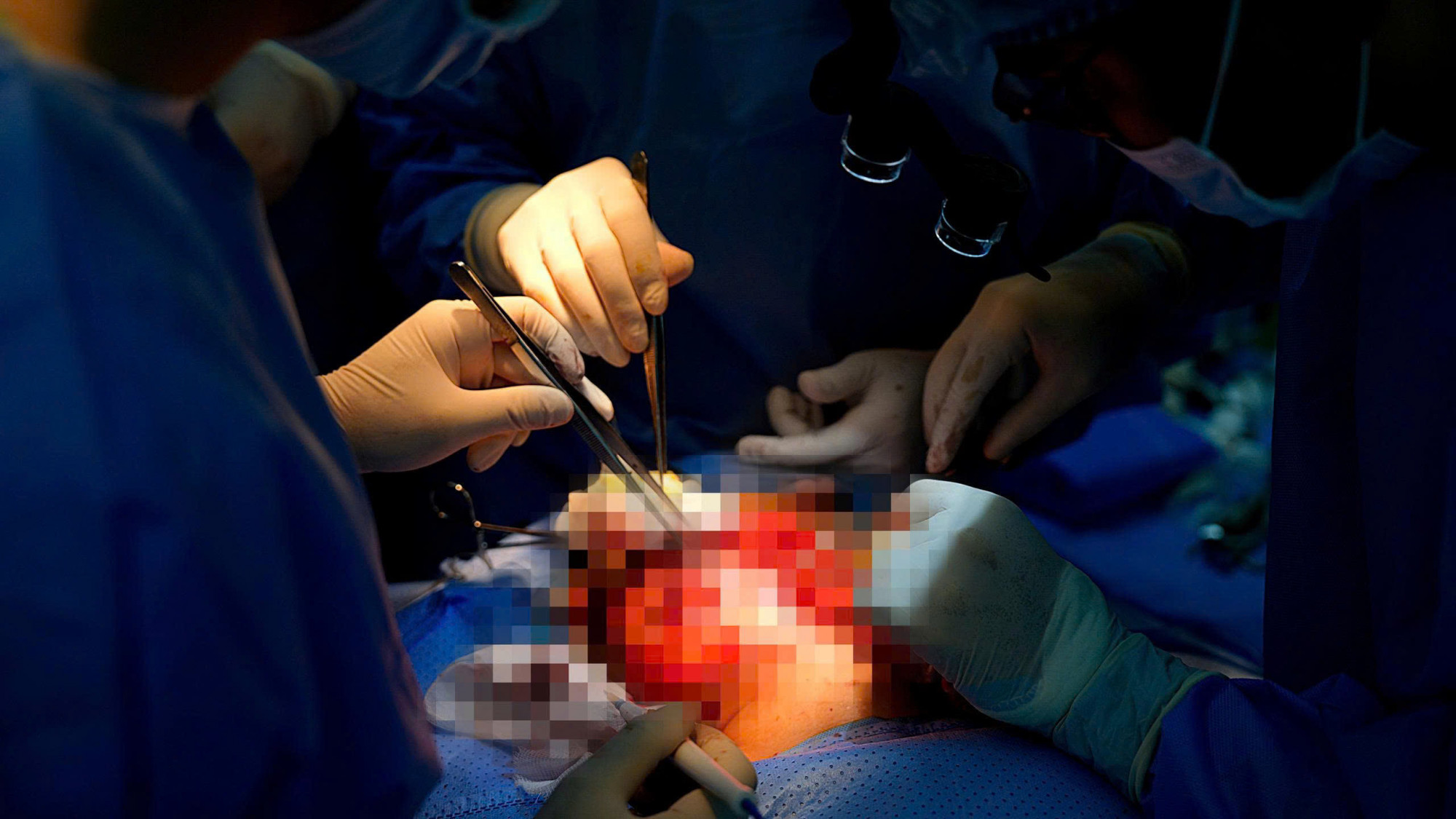 Ca phẫu thuật thực hiện cắt bỏ khối u, nạo vét hạch cổ, lấy xương mác và vi phẫu tái tạo xương hàm dưới được đánh giá khá phức tạp - Ảnh: Bệnh viện Trung ương Huế