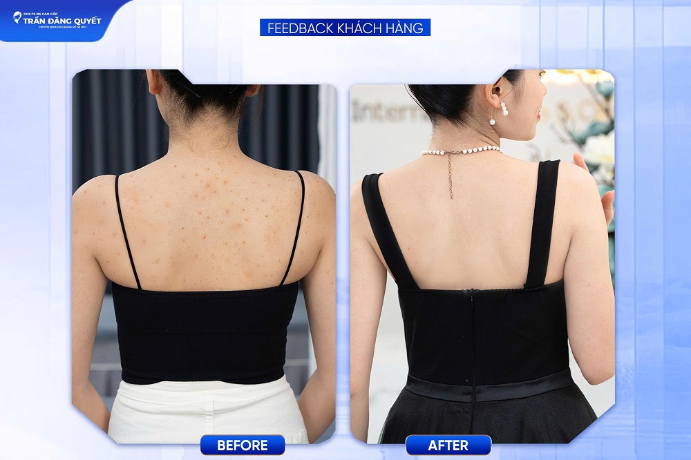 Kết quả điều trị viêm nang lông với phương pháp BioSkin
