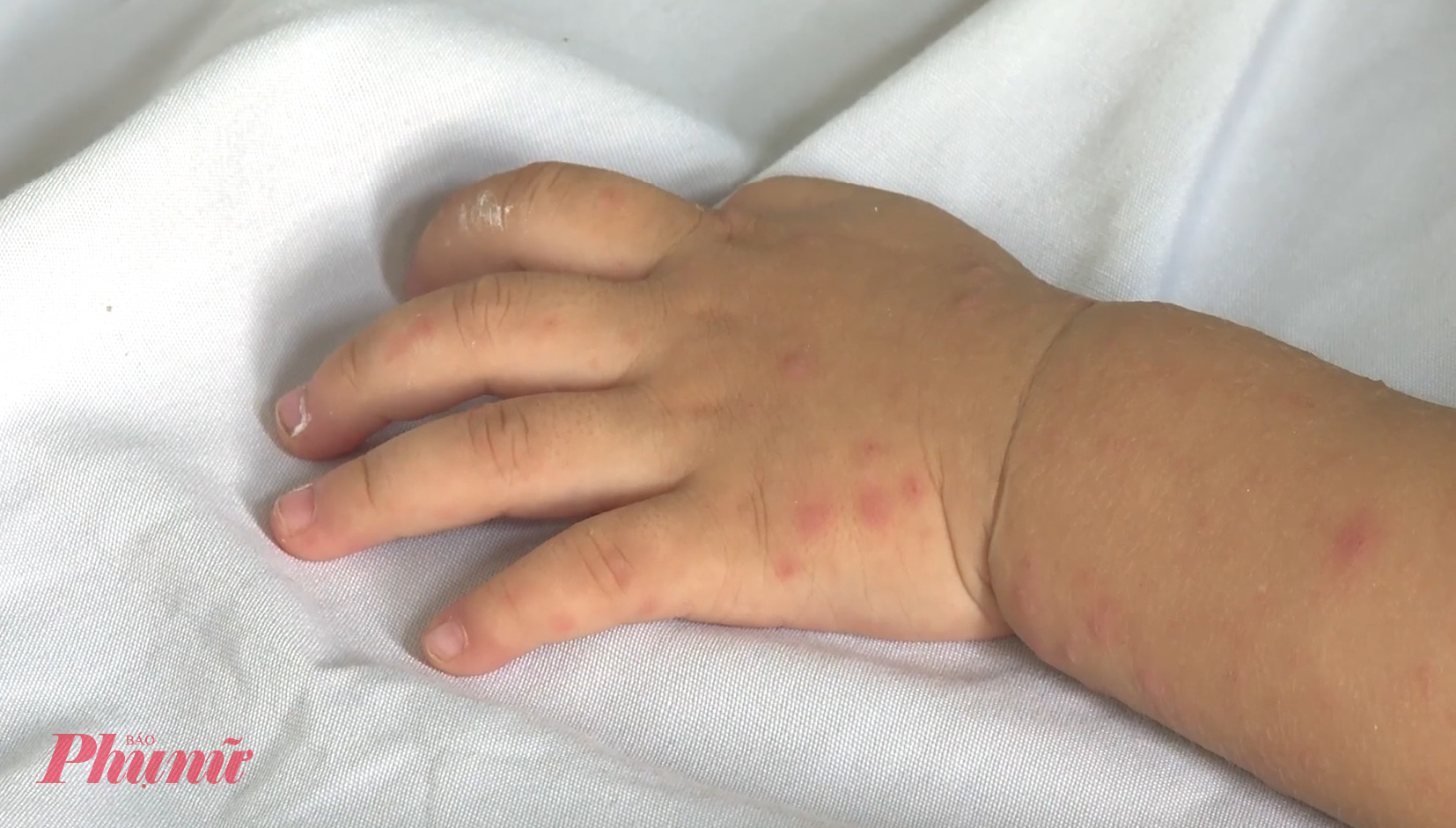 Trước sự xuất hiện rầm rộ của chủng virus EV71, phụ huynh cần đưa trẻ đi khám ngay khi có biểu hiện cảnh báo như sốt cao, uống thuốc không hạ, giật mình chới với, đi loạng choạng, ói nhiều, kể cả khi không thấy nổi ban hay loét miệng