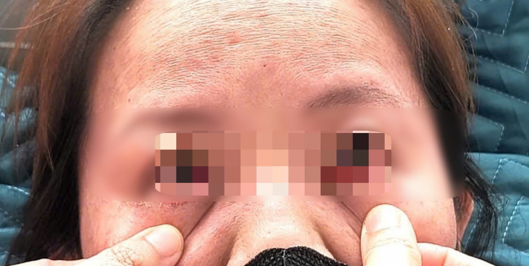 Bệnh nhân xuất huyết ở mắt do mắc sởi - ảnh Bệnh viện cung cấp