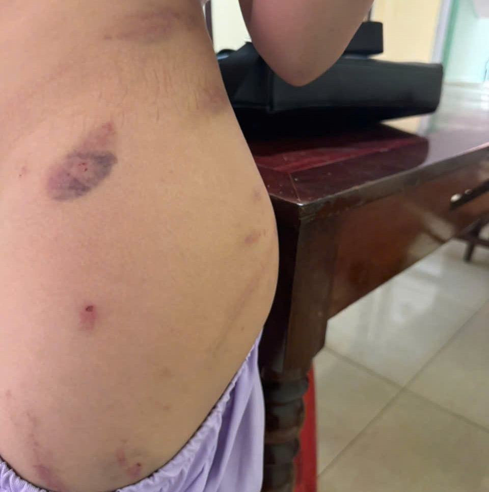 Cơ quan chức năng phát hiện có 34 dấu vết bầm trên cơ thể cháu bé - ảnh: B.T.