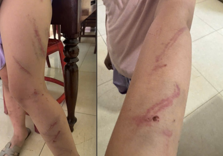 Nhiều vết bầm tím trên tay, chân của cháu B.A. - ảnh: B.T.