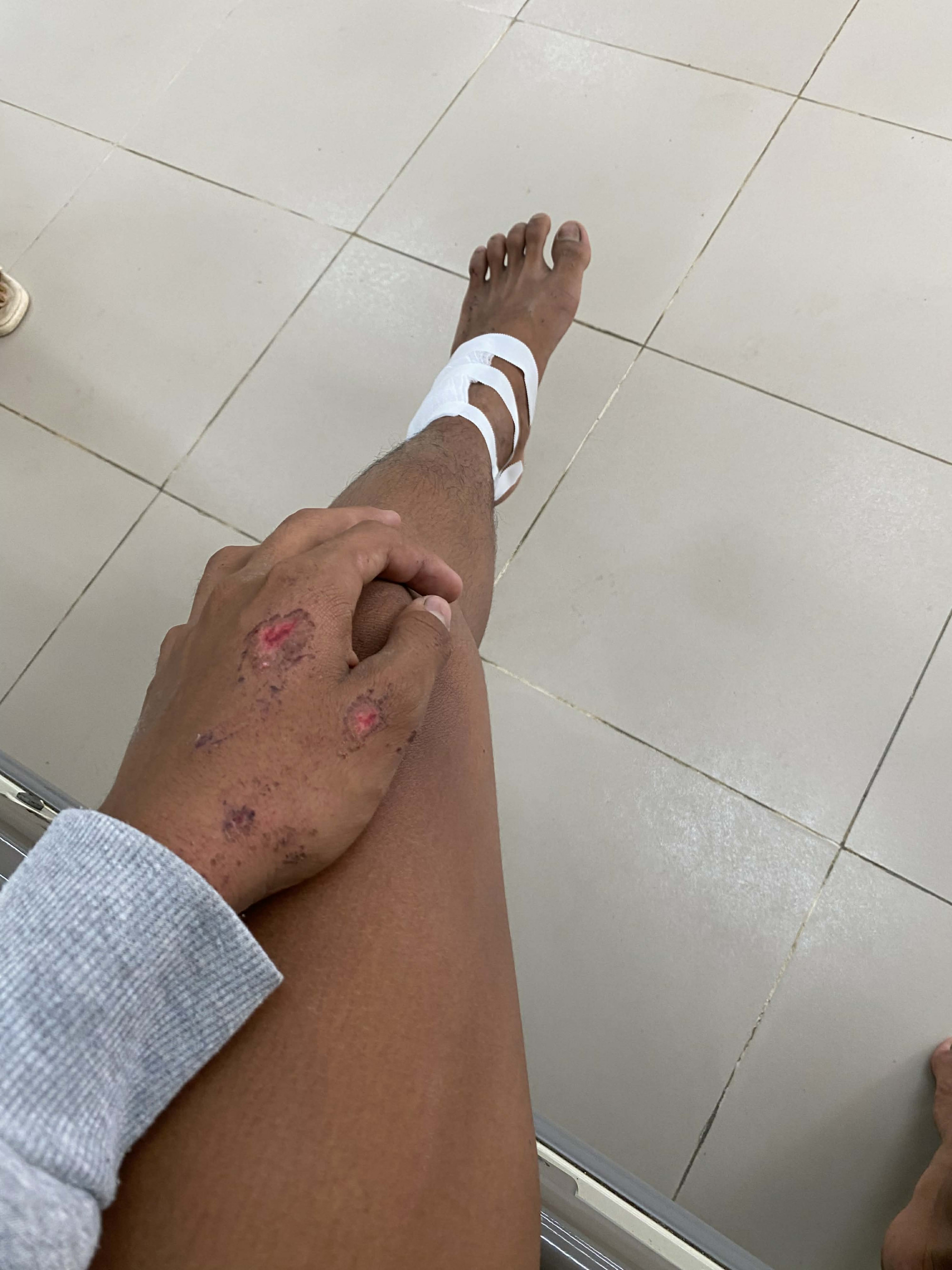 Thương tích đầy trên người D. sau sự việc. Ảnh: Minh Mẫn