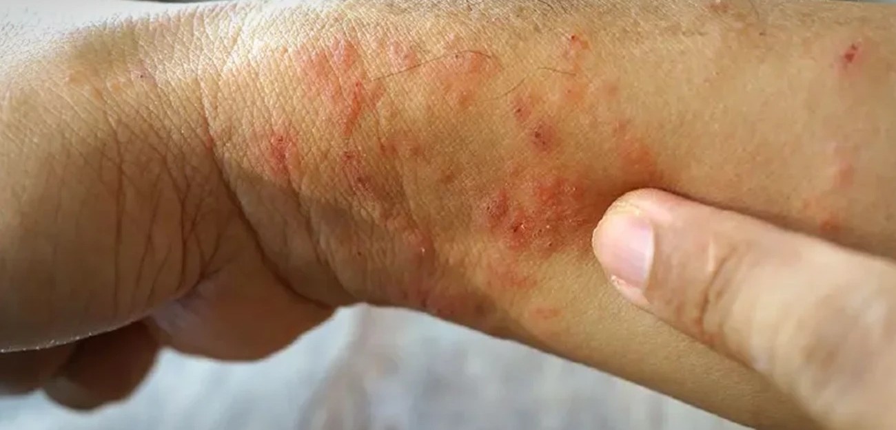 Các triệu chứng của bệnh “sốt đất” bao gồm từ sốt cao cấp tính và khó thở đến áp xe mãn tính và nhiễm trùng da - Ảnh: The Nation