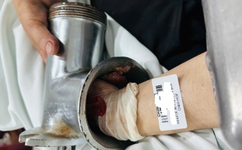 Tai nạn của chị R. khi được đưa đến bệnh viện, ảnh BVCC