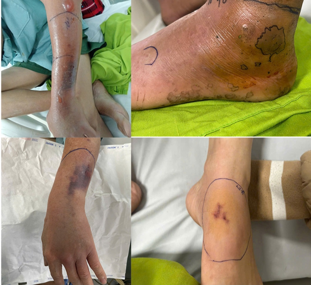 Một số ca bị rắn độc cắn được điều trị tại Bệnh viện đa khoa tỉnh Phú Thọ - ảnh: bệnh viện cung cấp