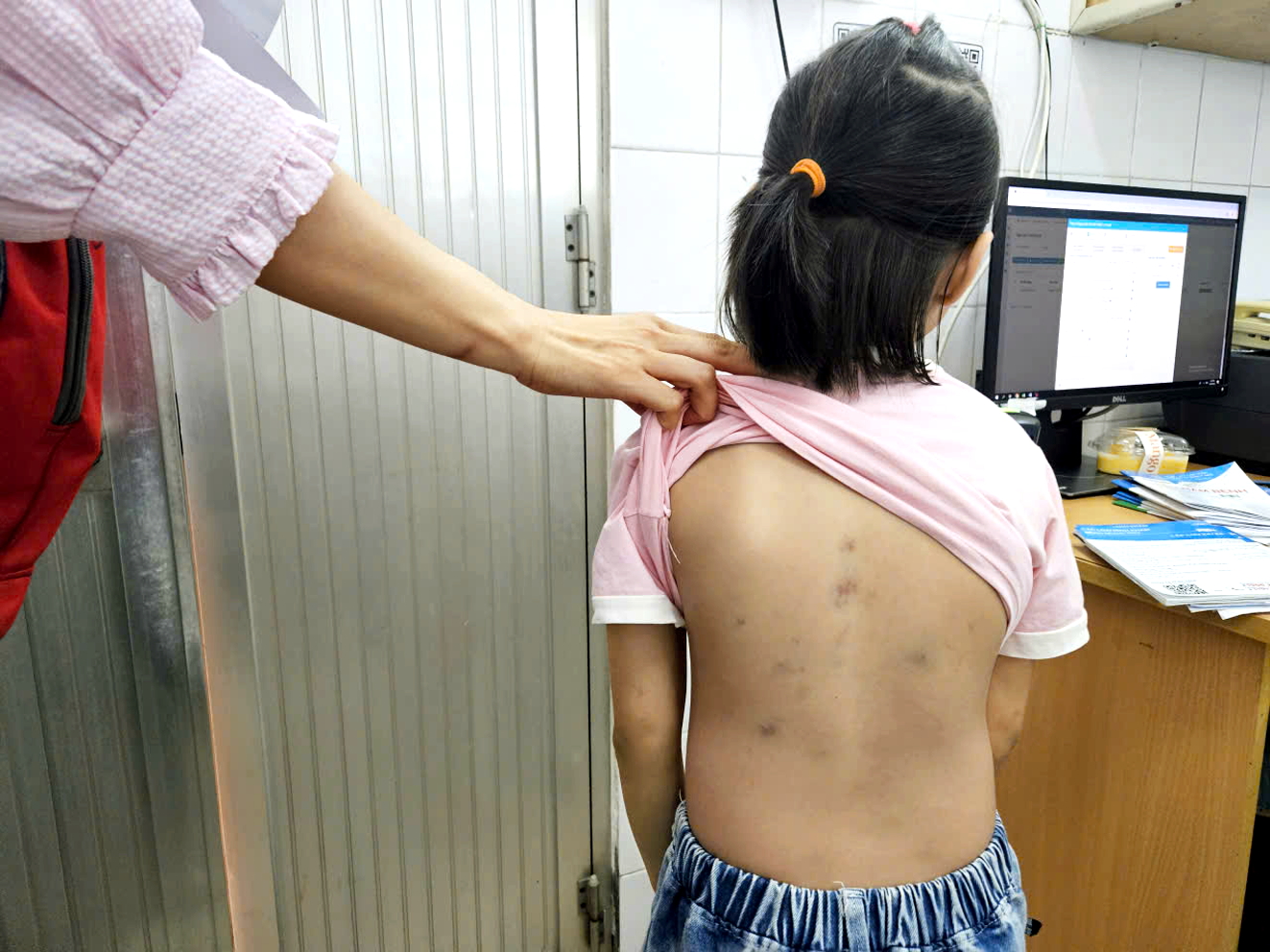 Bé gái bị chó cắn nhiều vết thương ở lưng