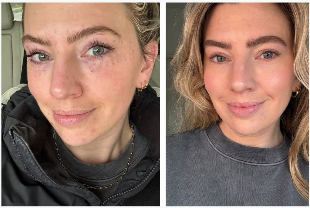 Laura Mulley - biên tập viên chuyên về làm đẹp và du lịch tại Anh - đã chia sẻ kinh nghiệm làm đẹp bằng tinh chất cá hồi với tờ Mirror - Ảnh: KP Aesthetics / Laura Mulley