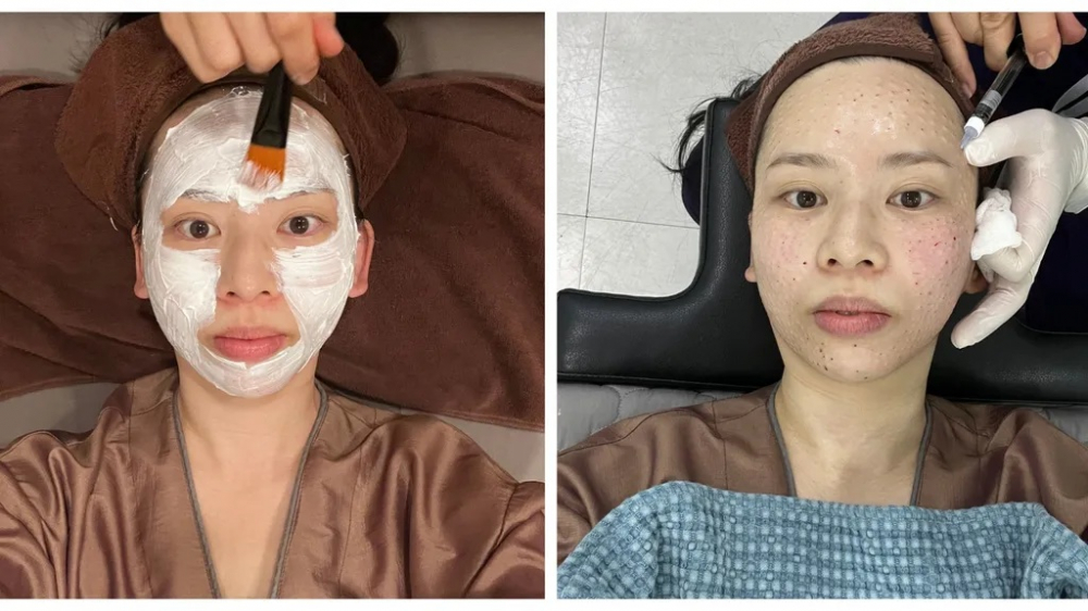 Quy trình làm sạch và ủ tê giúp đem lại cảm giác thoải mái nhất cho làn da trước các mũi tiêm - Ảnh: Sarah Y. Wu / Mariec Caire