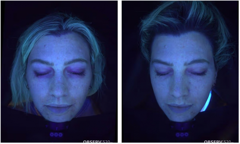 Laura nhận thấy sắc tố và vết rạn quanh mắt giảm đi sau khoảng 3 liệu trình - Ảnh: KP Aesthetics/ Laura Mulley