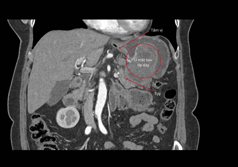 Khối u GIST dính vào tụy và mặt sau dạ dày gần tâm vị