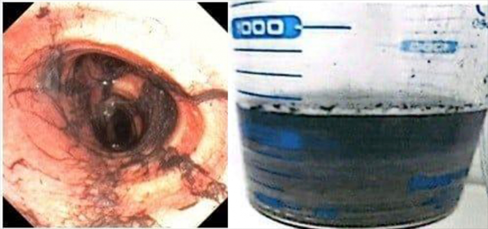 Đường thở của người bệnh bám nhiều bụi đen từ khói, tổn thương viêm sung huyết toàn bộ đường thở, chất tiết có rất nhiều muội than, tro bụi từ phổi của người bệnh được hút ra bằng phương pháp nội soi phế quản ống mềm tại giường (kết quả nội soi phế quản ống mềm tại giường thực hiện tại Bệnh viện Nhân dân 115, ngày 12/4/2026)