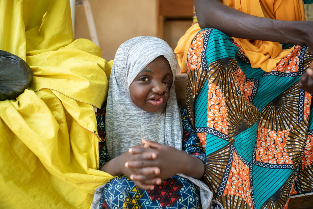 Sakina, một bé gái 6 tuổi sống sót sau căn bệnh Noma, đến từ bang Sokoto, Nigeria - Ảnh: Claire Jeantet