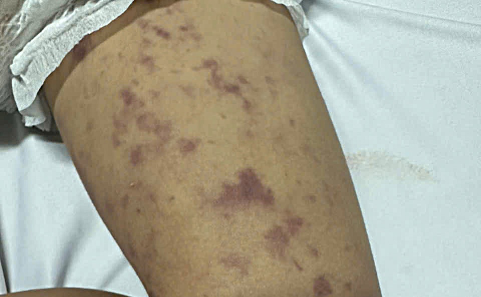  Bệnh nhi mắc viêm não mô cầu xuát hiện những nốt tử ban trên da khắp cơ thể - ảnh: Quang Nhật