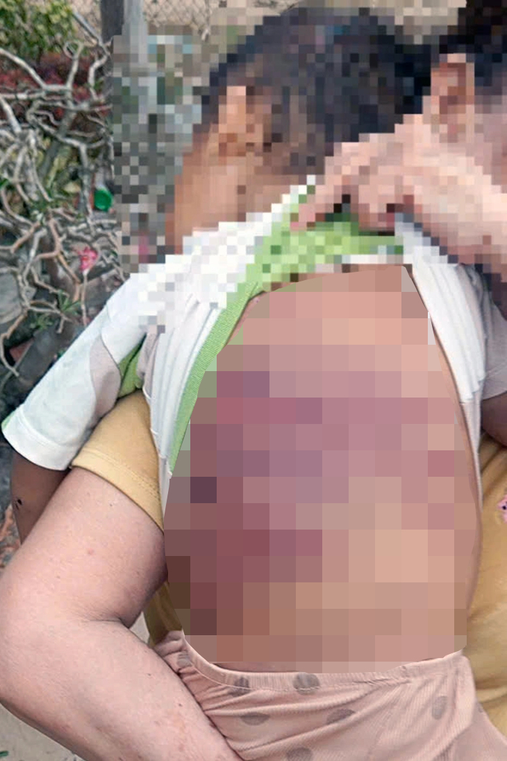 Vết thương trên người bé trai 2 tuổi bị mẹ và tình nhân bạo hành dẫn đến hôn mê tại TPHCM - Ảnh: Công an TPHCM