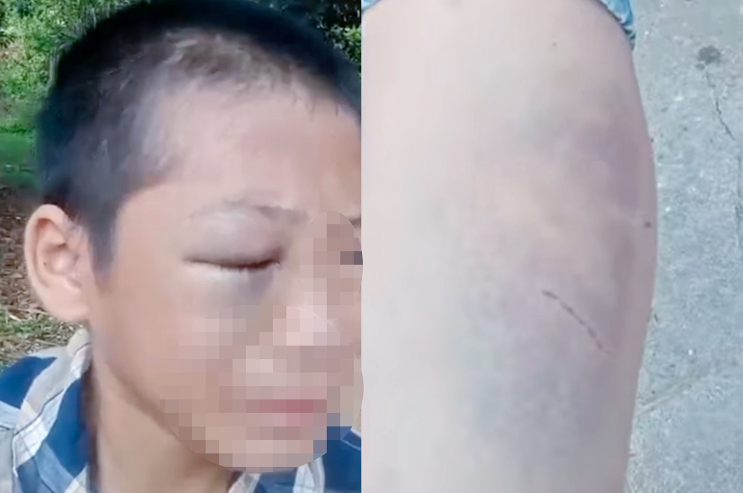 Nam sinh có nhiều vết bầm tím trên mặt, tay và chân - Ảnh cắt từ clip