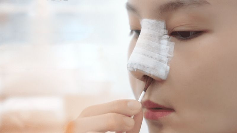 Nhiều trường hợp bị biến chứng vì nâng mũi quá cao cần phải tháo sụn mũi - Ảnh minh họa: Pixabay