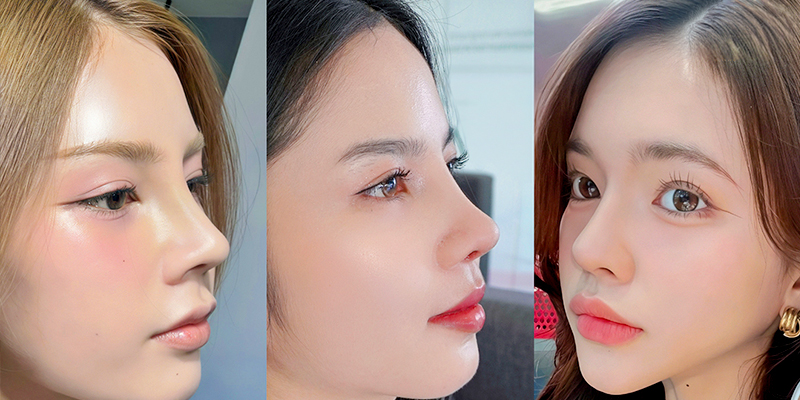 Mũi sau khi tháo sụn có da chùng nhiều hơn vì đã bị kéo giãn lâu, thường cần ghép mỡ hoặc trung bì ngay lúc tháo để giữ form tạm thời và chống lõm. 